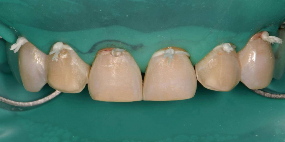Эстетическая реабилитация фронтальной группы зубов методом прямой композитной реставрации - фото №3