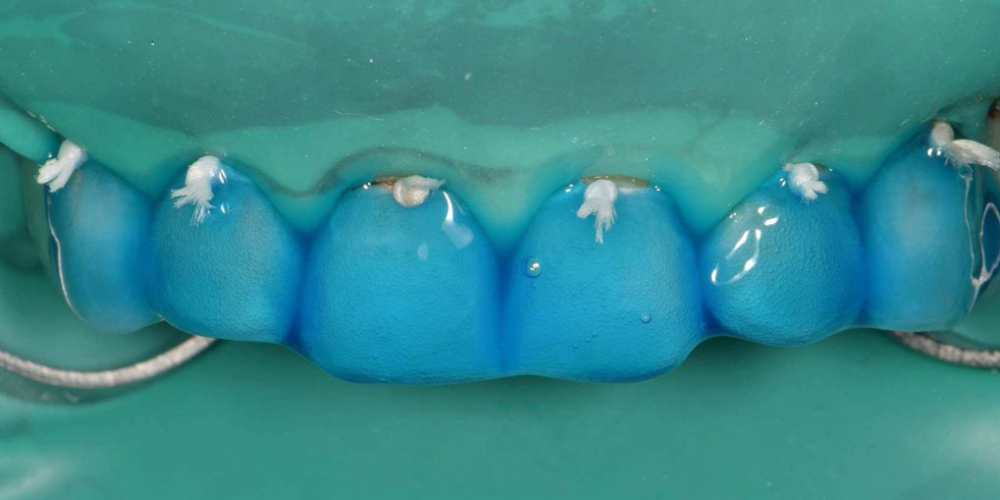 Эстетическая реабилитация фронтальной группы зубов методом прямой композитной реставрации - фото №4
