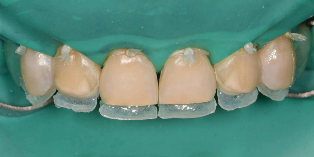 Эстетическая реабилитация фронтальной группы зубов методом прямой композитной реставрации - фото №6