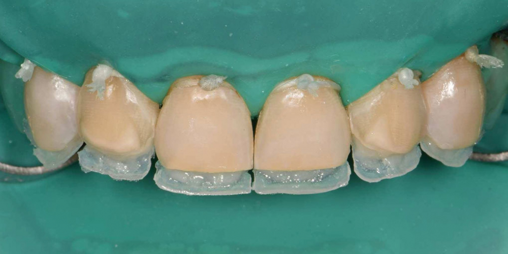 Эстетическая реабилитация фронтальной группы зубов методом прямой композитной реставрации - фото №7