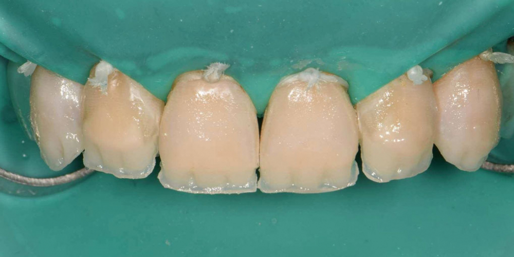 Эстетическая реабилитация фронтальной группы зубов методом прямой композитной реставрации - фото №8