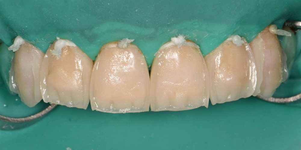 Эстетическая реабилитация фронтальной группы зубов методом прямой композитной реставрации - фото №9