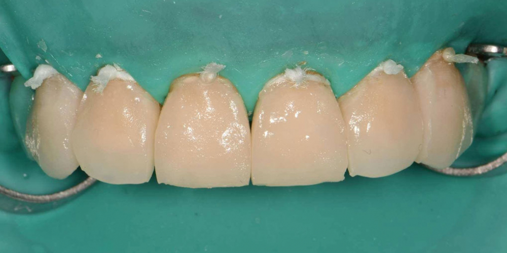 Эстетическая реабилитация фронтальной группы зубов методом прямой композитной реставрации - фото №2