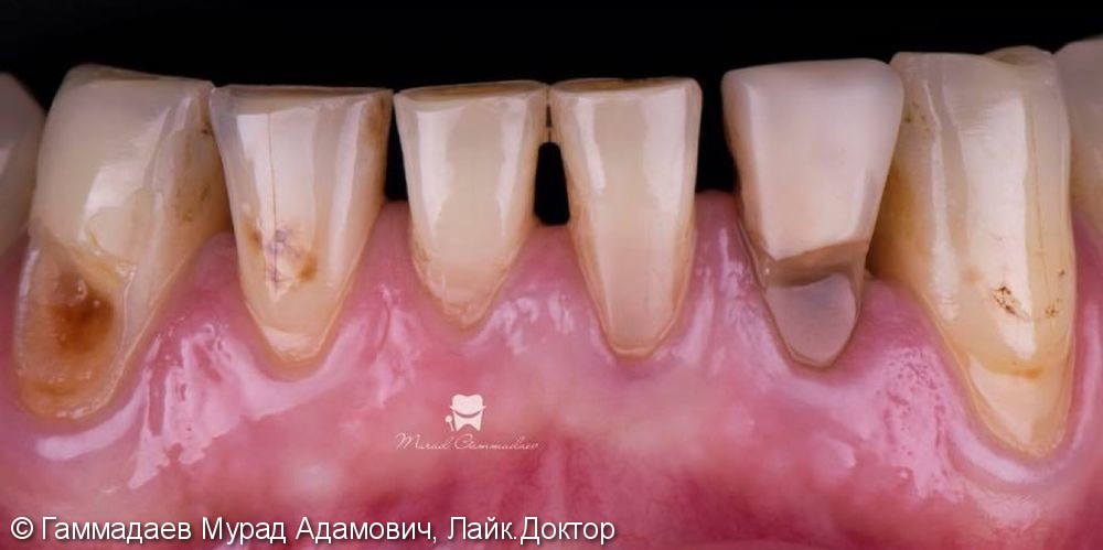 Реставрация фронта нижней челюсти с имитацией трещин и некариозных дефектов - фото №1