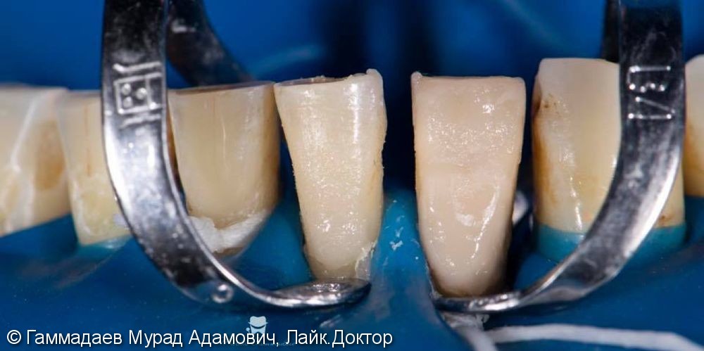 Реставрация фронта нижней челюсти с имитацией трещин и некариозных дефектов - фото №5