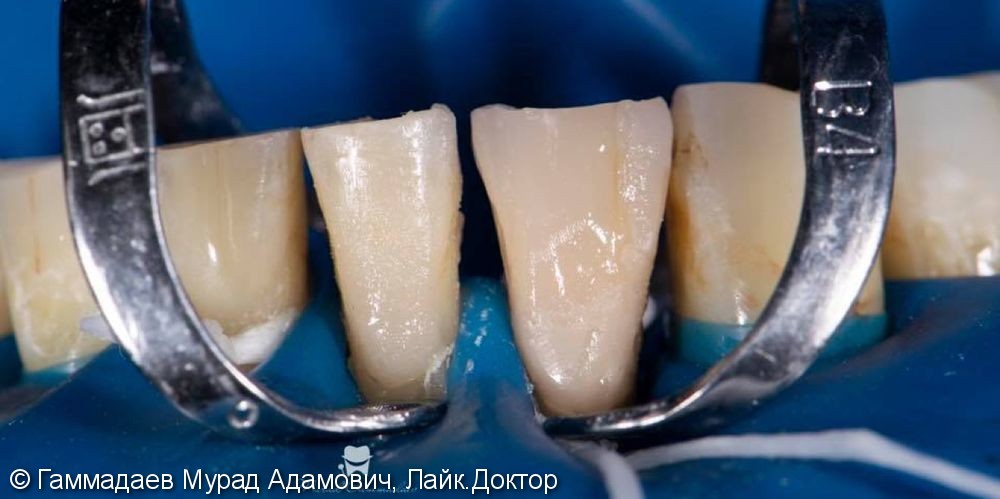 Реставрация фронта нижней челюсти с имитацией трещин и некариозных дефектов - фото №7