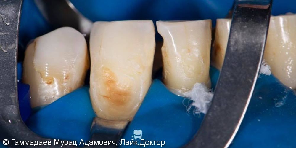 Реставрация фронта нижней челюсти с имитацией трещин и некариозных дефектов - фото №9