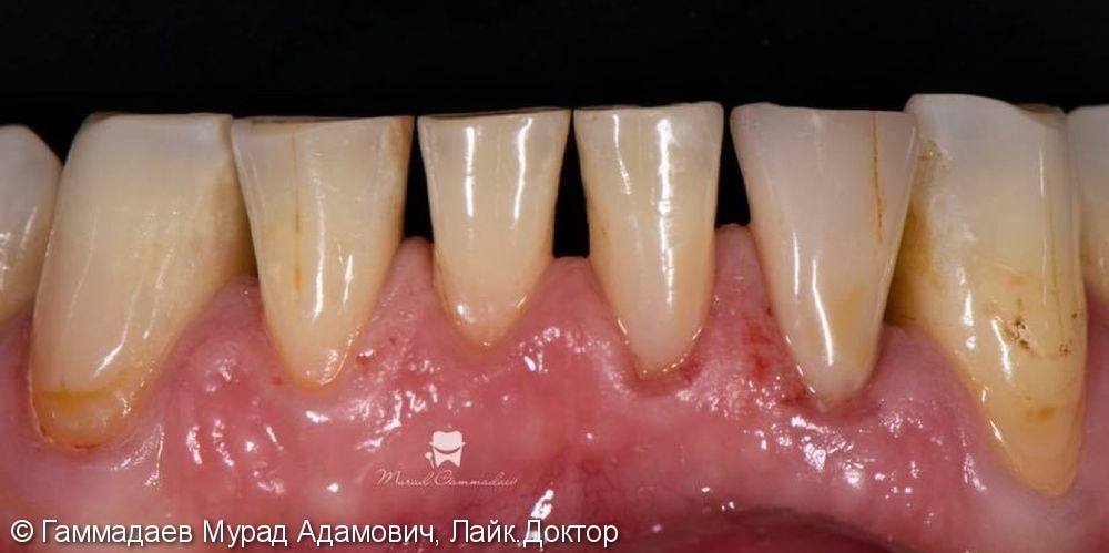 Реставрация фронта нижней челюсти с имитацией трещин и некариозных дефектов - фото №11