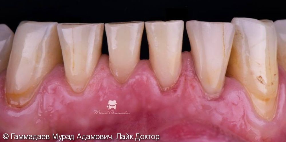 Реставрация фронта нижней челюсти с имитацией трещин и некариозных дефектов - фото №12