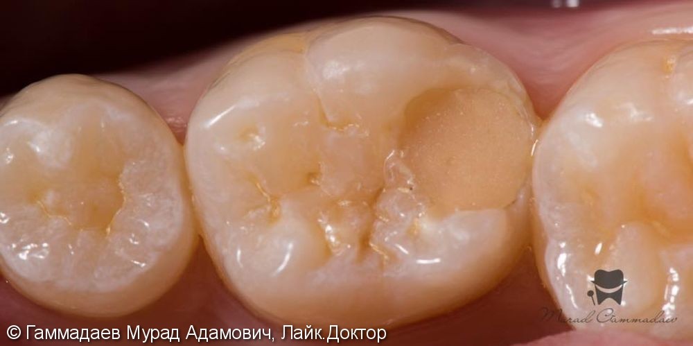 Поэтапная реставрация жевательного зуба: до, после и в процессе - фото №1