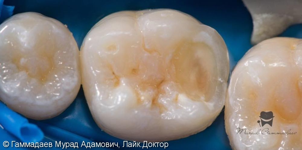 Поэтапная реставрация жевательного зуба: до, после и в процессе - фото №2