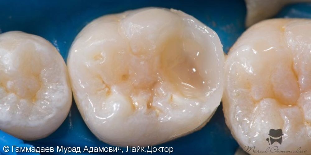 Поэтапная реставрация жевательного зуба: до, после и в процессе - фото №4