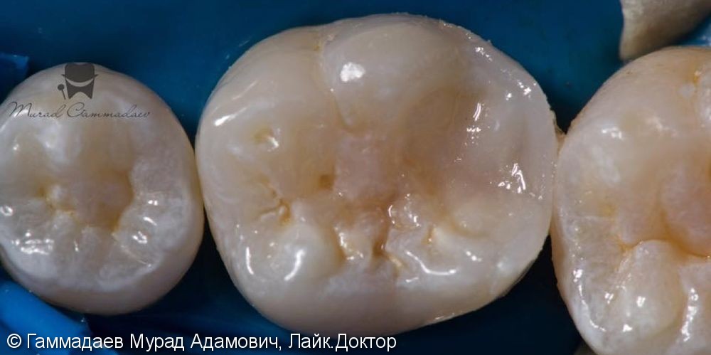 Поэтапная реставрация жевательного зуба: до, после и в процессе - фото №5