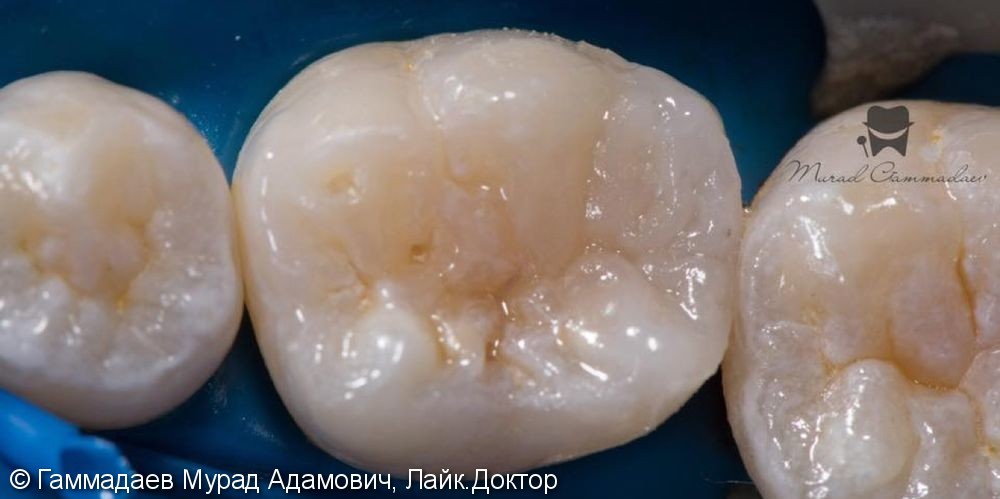 Поэтапная реставрация жевательного зуба: до, после и в процессе - фото №6