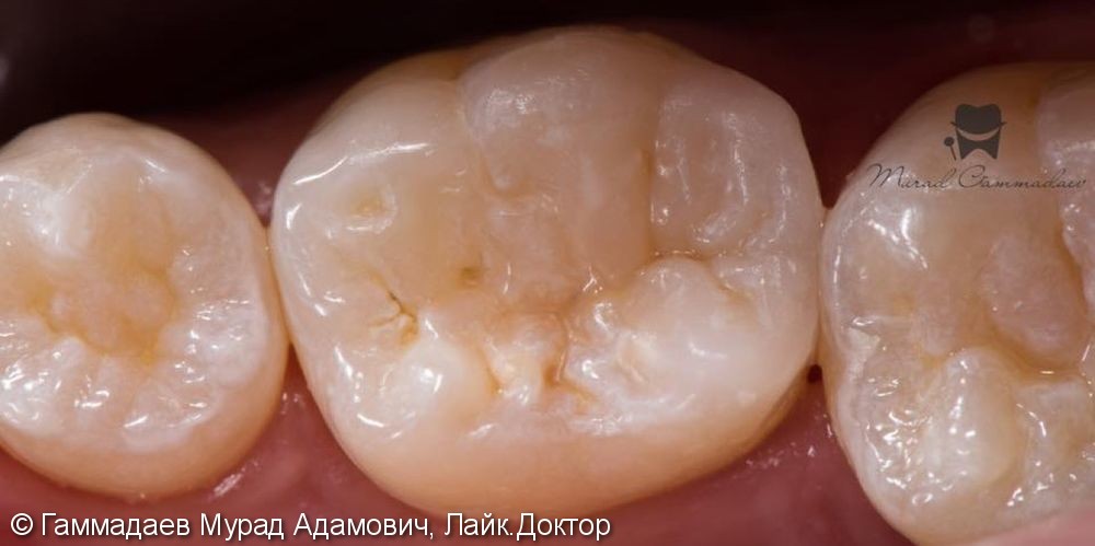 Поэтапная реставрация жевательного зуба: до, после и в процессе - фото №7