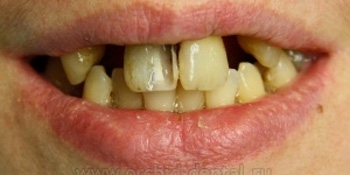 Имплантация зубов, металлокерамическая коронка - фото №1
