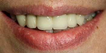 Имплантация зубов, металлокерамическая коронка - фото №2