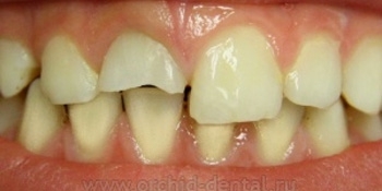 Эстетическая реставрация переднего зуба - фото №1
