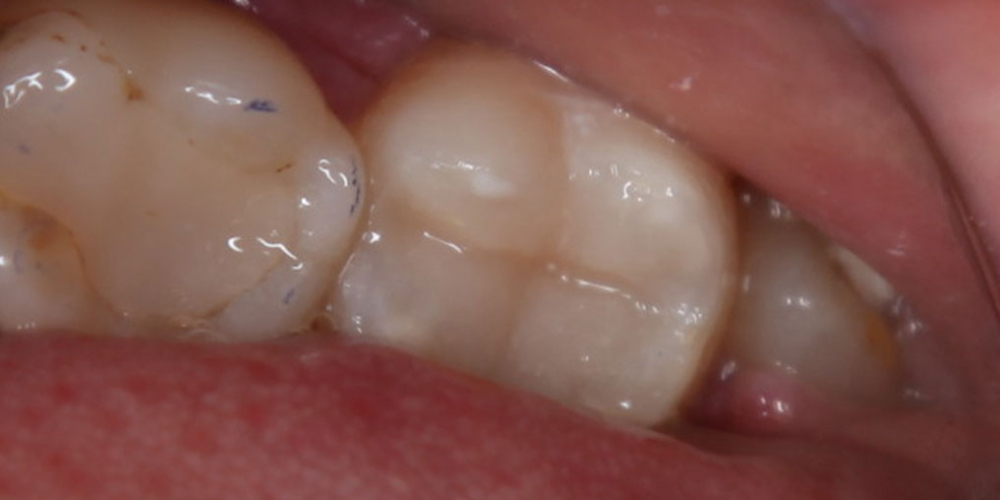 Лечение кариеса 37 зуба - фото №4