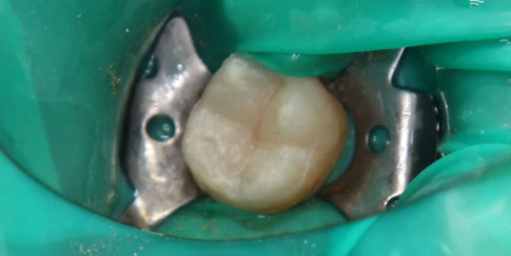 Лечение кариеса 37 зуба - фото №2