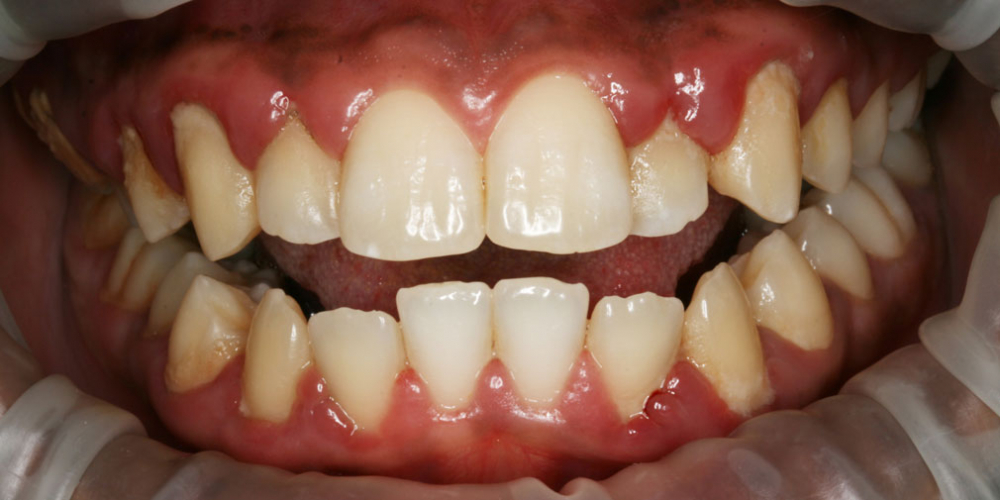 Результат профессиональной чистки зубов от темного налета - фото №1