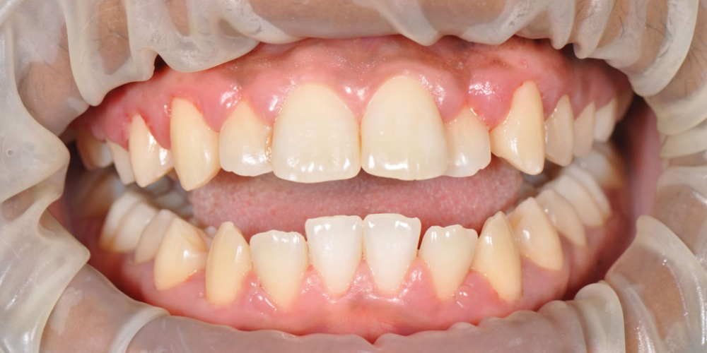 Результат профессиональной чистки зубов от темного налета - фото №2