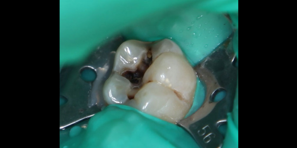 Результат лечения кариеса с восстановлением анатомической формы зуба - фото №1