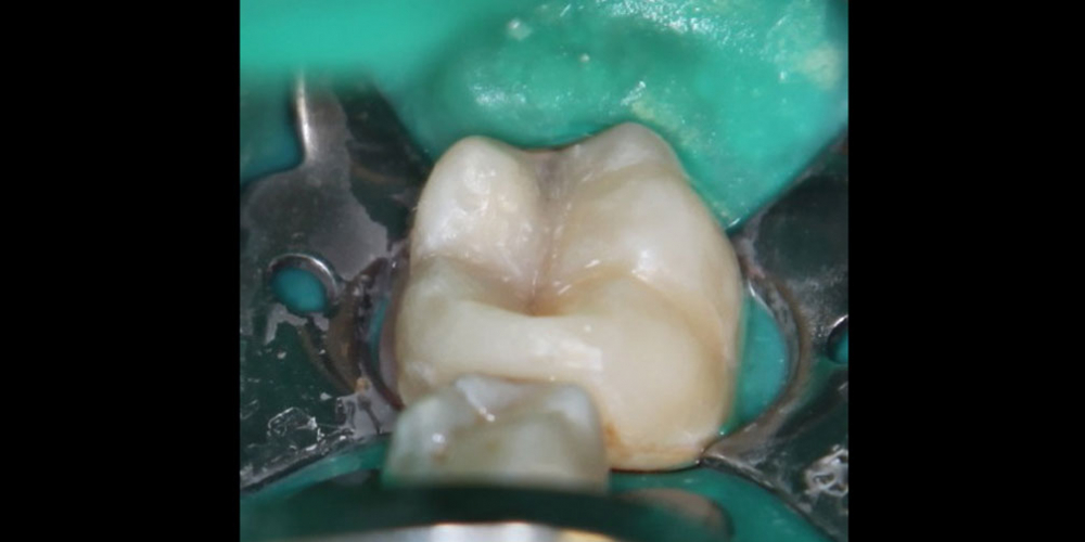 Результат лечения кариеса с восстановлением анатомической формы зуба - фото №3