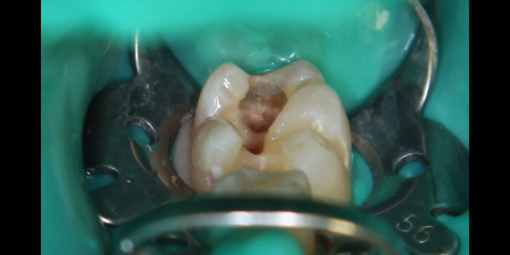Результат лечения кариеса с восстановлением анатомической формы зуба - фото №2