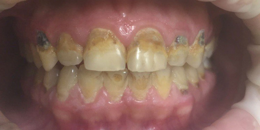 Реставрация 8 верхних зубов: резцов, клыков и премоляров - фото №1