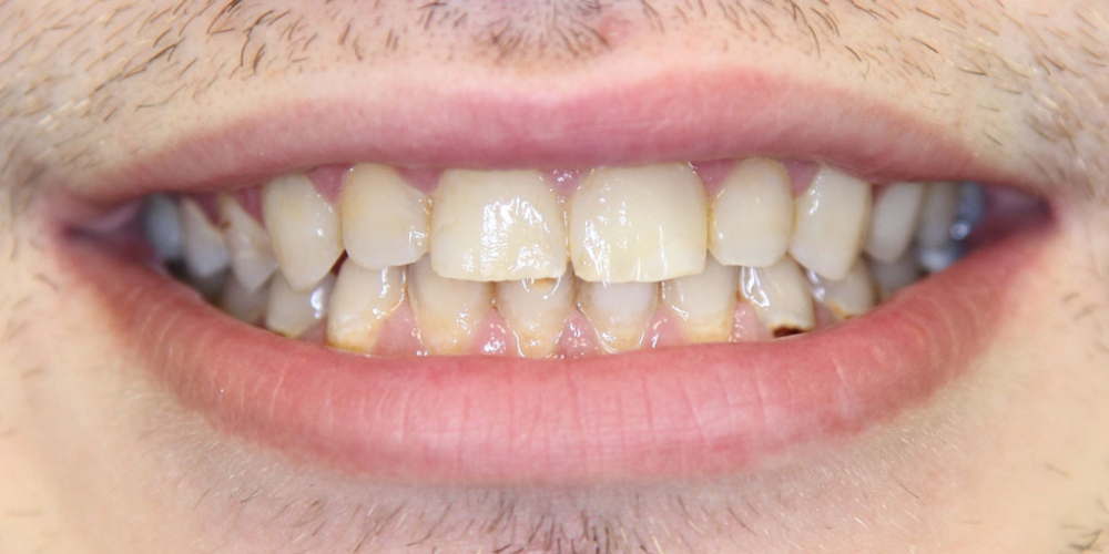Реставрация 8 верхних зубов: резцов, клыков и премоляров - фото №2