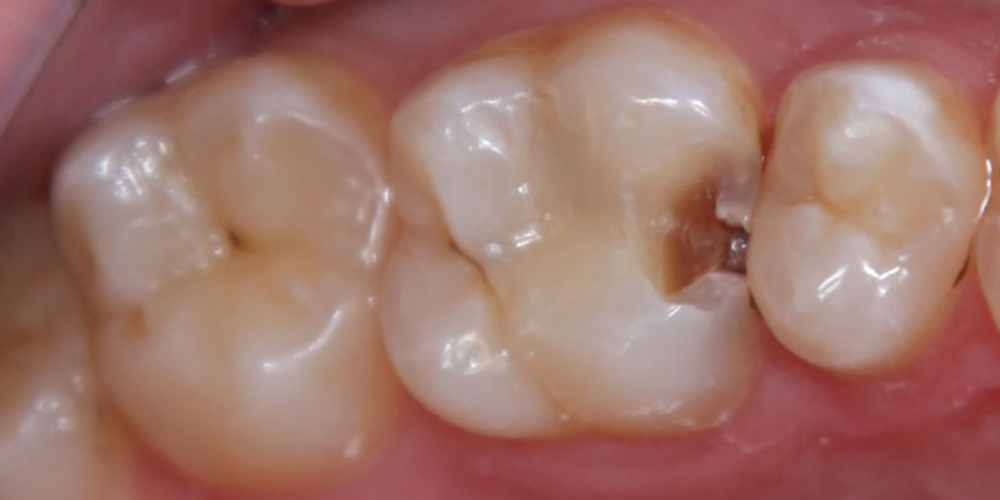 Кариозная полость на контактной поверхности зуба 2.6 - фото №1