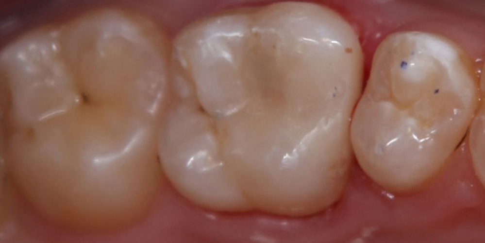 Кариозная полость на контактной поверхности зуба 2.6 - фото №2
