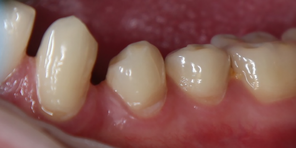 Лечение клиновидного дефекта 3-х зубов - фото №1