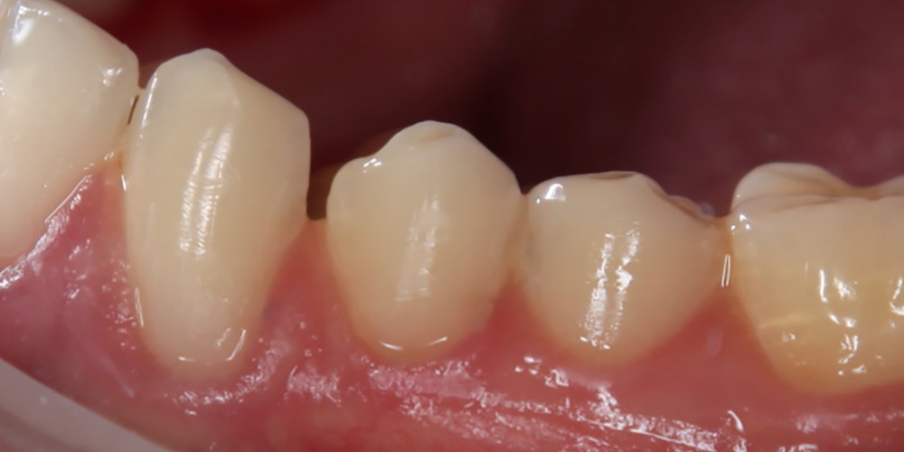 Лечение клиновидного дефекта 3-х зубов - фото №2