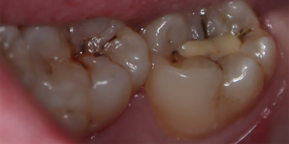 Лечение кариеса 47 зуба - фото №1
