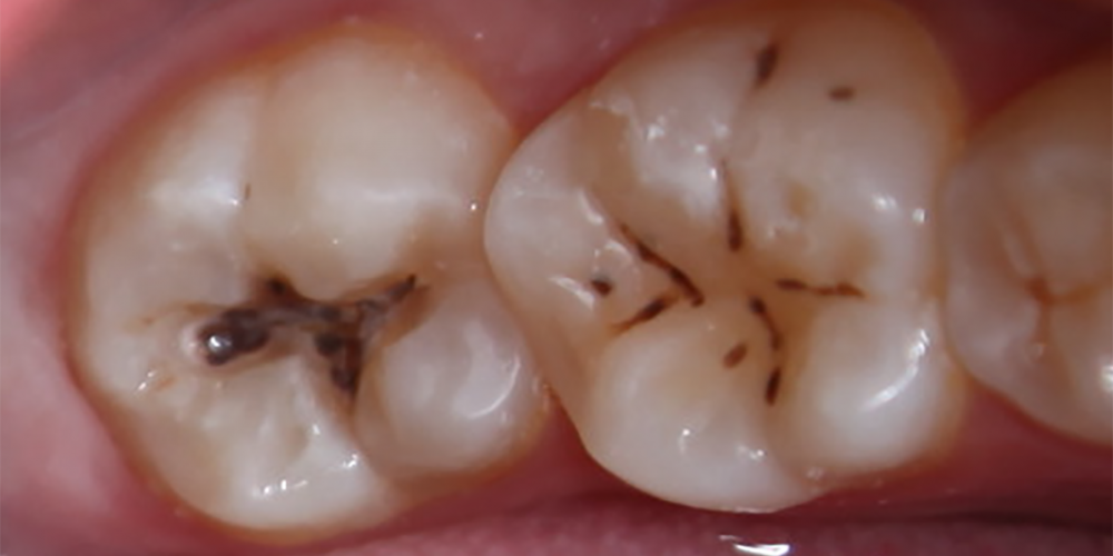 Лечение кариеса зуба 3.7 - фото №1