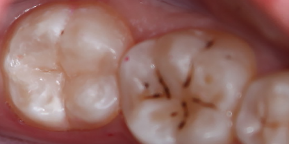 Лечение кариеса зуба 3.7 - фото №2
