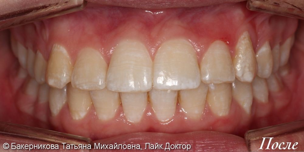 Ортодонтическое лечение скелетного и зубо-альвеолярного III класса на брекет-системе Damon Q - фото №4
