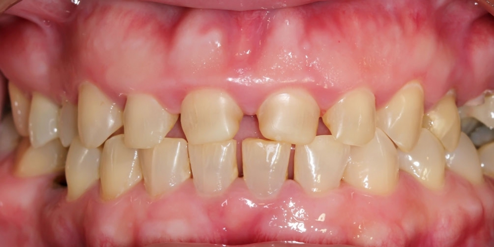 Установка виниров при патологической стираемости зубов - фото №1