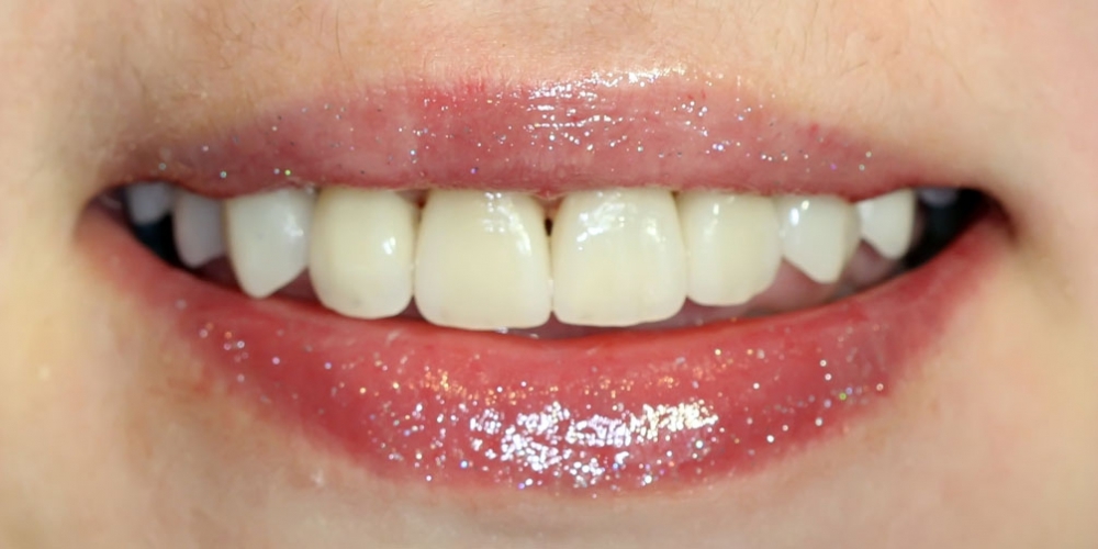 Установка виниров при патологической стираемости зубов - фото №2
