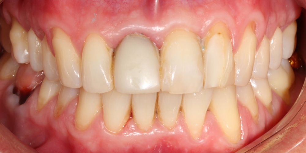 Керамические виниры на передние зубы - фото №1