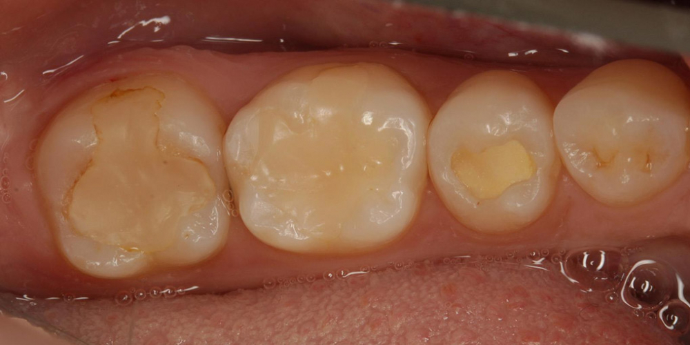 Лечение кариеса и реставрация жевательных зубов - фото №1