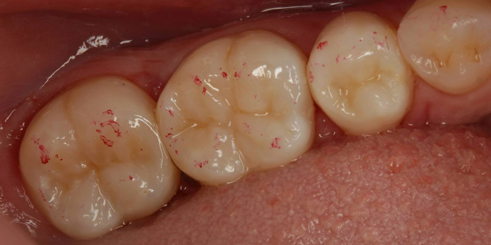Лечение кариеса и реставрация жевательных зубов - фото №4