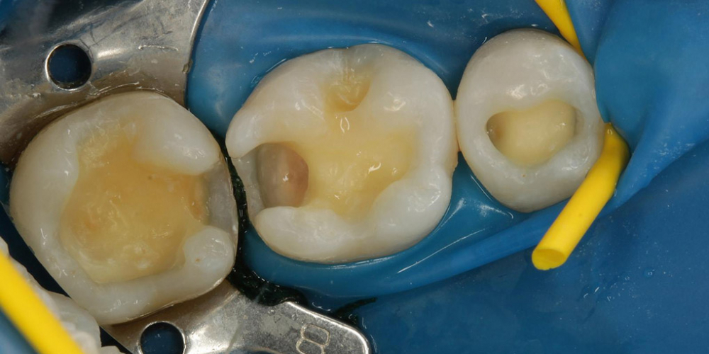 Лечение кариеса и реставрация жевательных зубов - фото №3