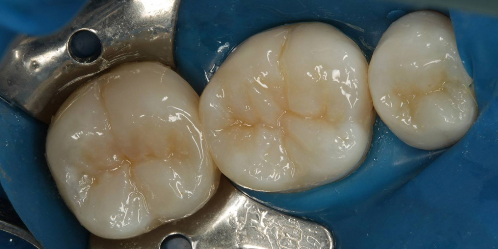 Лечение кариеса и реставрация жевательных зубов - фото №2