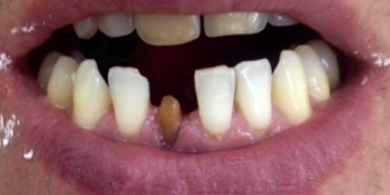 Ревставрация зубов коронкой E-MAX - фото №1