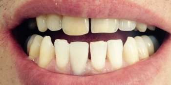 Ревставрация зубов коронкой E-MAX - фото №2
