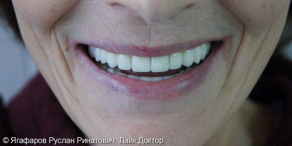 Восстановление зубов с помощью имплантов - фото №2