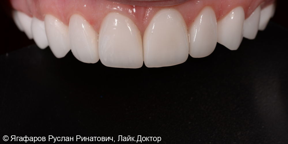 Виниры фото 4 · Уфа